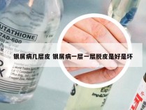 银屑病几层皮 银屑病一层一层脱皮是好是坏