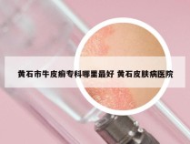 黄石市牛皮癣专科哪里最好 黄石皮肤病医院