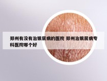 郑州有没有治银屑病的医院 郑州治银屑病专科医院哪个好
