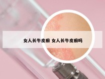 女人长牛皮癣 女人长牛皮癣吗