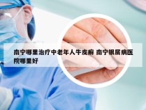 南宁哪里治疗中老年人牛皮癣 南宁银屑病医院哪里好