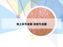 背上长牛皮藓 后背牛皮廨