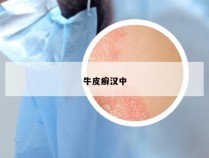 牛皮癣汉中