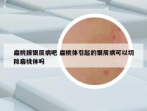 扁桃腺银屑病吧 扁桃体引起的银屑病可以切除扁桃体吗