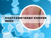 苏州治疗牛皮癣哪个医院最好 苏州哪家银屑病医院好