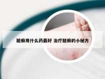 腿癣用什么药最好 治疗腿癣的小秘方