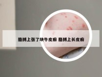 胳膊上张了块牛皮癣 胳膊上长皮癣