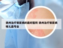 扬州治疗银屑病的最好医院 扬州治疗银屑病哪儿最专业