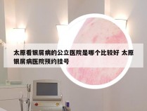太原看银屑病的公立医院是哪个比较好 太原银屑病医院预约挂号