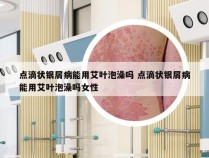点滴状银屑病能用艾叶泡澡吗 点滴状银屑病能用艾叶泡澡吗女性
