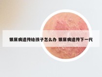 银屑病遗传给孩子怎么办 银屑病遗传下一代