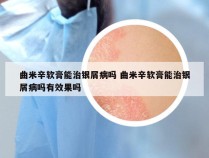 曲米辛软膏能治银屑病吗 曲米辛软膏能治银屑病吗有效果吗