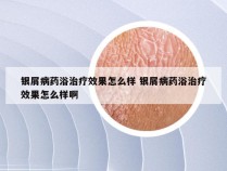 银屑病药浴治疗效果怎么样 银屑病药浴治疗效果怎么样啊