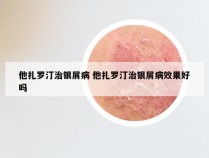 他扎罗汀治银屑病 他扎罗汀治银屑病效果好吗