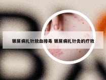 银屑病扎针放血排毒 银屑病扎针灸的疗效