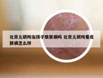 北京儿研所治孩子银屑病吗 北京儿研所看皮肤病怎么样