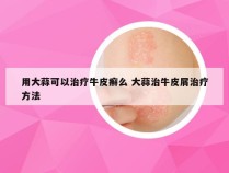 用大蒜可以治疗牛皮癣么 大蒜治牛皮屑治疗方法