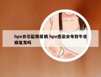 hpv会引起银屑病 hpv感染会导致牛皮癣复发吗