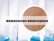 银屑病会影响月经吗 银屑病对月经的影响