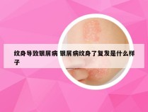 纹身导致银屑病 银屑病纹身了复发是什么样子