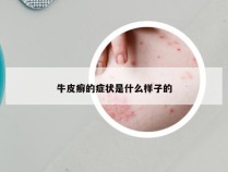 牛皮癣的症状是什么样子的