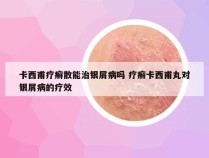 卡西甫疗癣散能治银屑病吗 疗癣卡西甫丸对银屑病的疗效