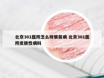 北京301医院怎么样银屑病 北京301医院皮肤性病科