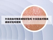 针灸放血对银屑病有好处吗 针灸放血对银屑病有好处吗视频