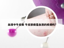 血液中牛皮癣 牛皮肤癣是血液的疾病吗?