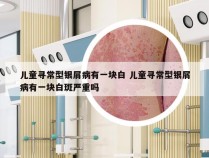 儿童寻常型银屑病有一块白 儿童寻常型银屑病有一块白斑严重吗