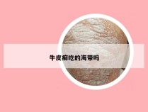 牛皮癣吃的海带吗