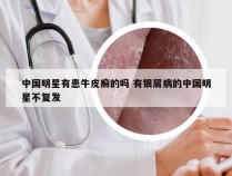 中国明星有患牛皮癣的吗 有银屑病的中国明星不复发