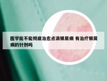 医学能不能彻底治愈点滴银屑病 有治疗银屑病的针剂吗