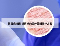 银屑病法国 银屑病的国外最新治疗方案
