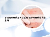 小孩的头皮癣怎么引起的 孩子头皮癣容易痊愈吗