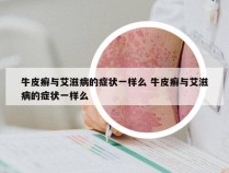 牛皮癣与艾滋病的症状一样么 牛皮癣与艾滋病的症状一样么