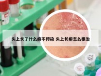 头上长了什么癣不传染 头上长癣怎么根治