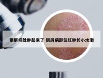 银屑病处肿起来了 银屑病部位红肿长小水泡