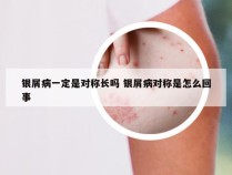 银屑病一定是对称长吗 银屑病对称是怎么回事