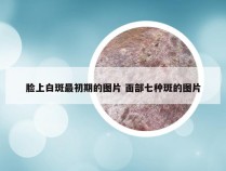 脸上白斑最初期的图片 面部七种斑的图片