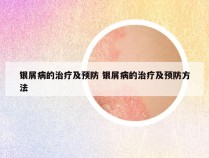 银屑病的治疗及预防 银屑病的治疗及预防方法