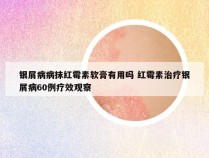 银屑病病抹红霉素软膏有用吗 红霉素治疗银屑病60例疗效观察