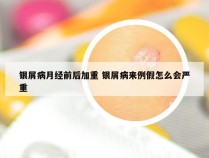 银屑病月经前后加重 银屑病来例假怎么会严重