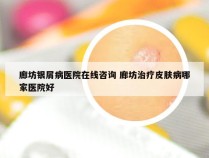 廊坊银屑病医院在线咨询 廊坊治疗皮肤病哪家医院好