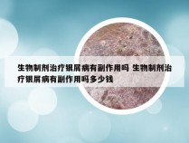 生物制剂治疗银屑病有副作用吗 生物制剂治疗银屑病有副作用吗多少钱