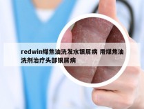 redwin煤焦油洗发水银屑病 用煤焦油洗剂治疗头部银屑病