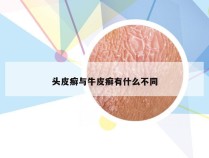 头皮癣与牛皮癣有什么不同