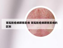 掌跖脓疱病跟银屑病 掌跖脓疱病跟银屑病的区别