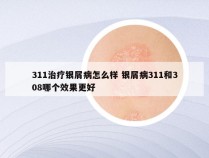 311治疗银屑病怎么样 银屑病311和308哪个效果更好