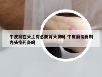 牛皮癣在头上有必要剪头发吗 牛皮癣需要剃光头擦药膏吗